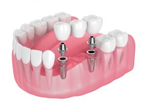 graphic of an implant supported bridge